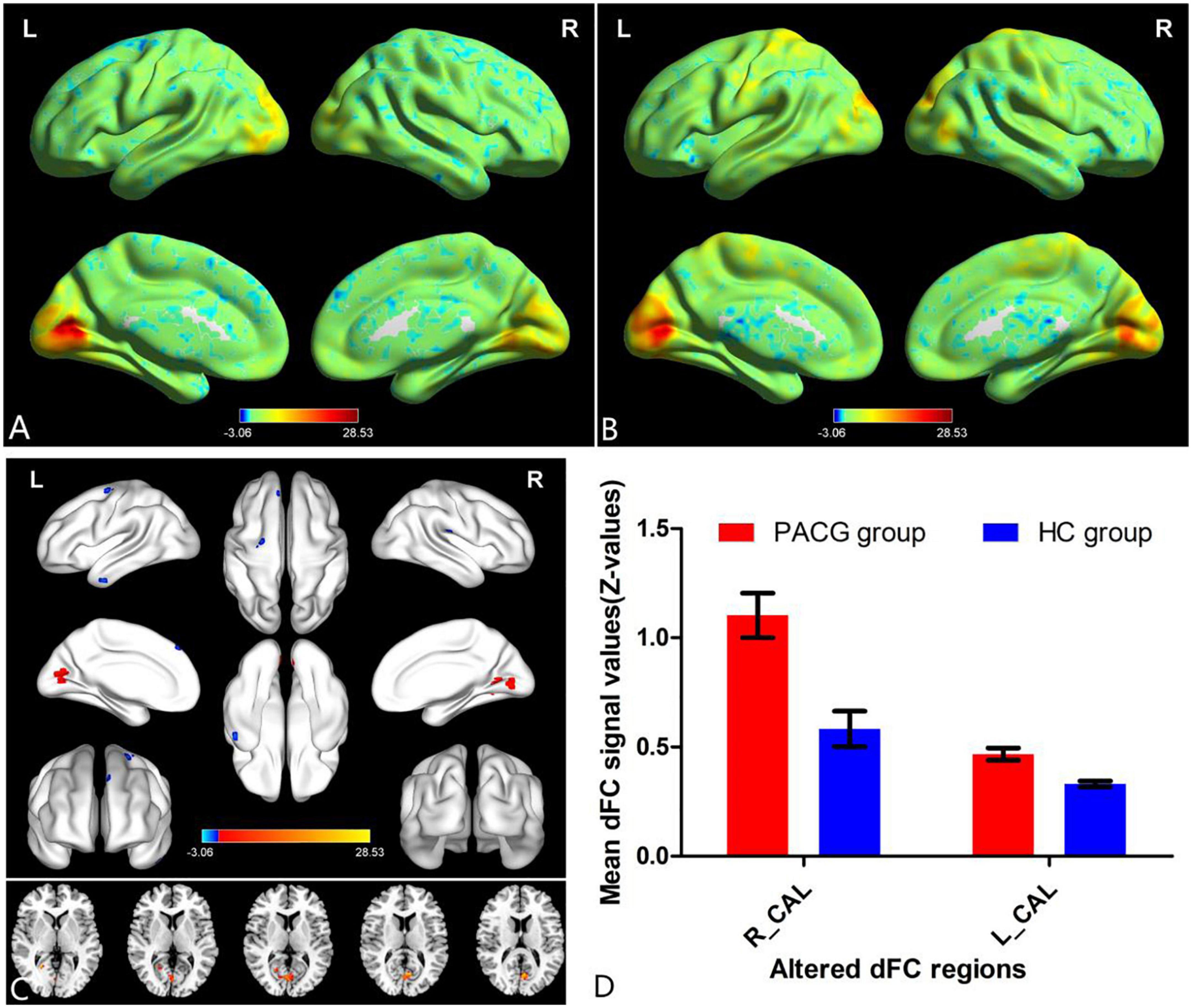 Altered dynamic functional connectivity in the primary visual cortex in patients with primary angle-closure glaucoma